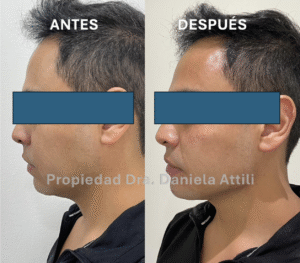 Antes y Después de Perfilamiento Mandibular con ácido hialurónico